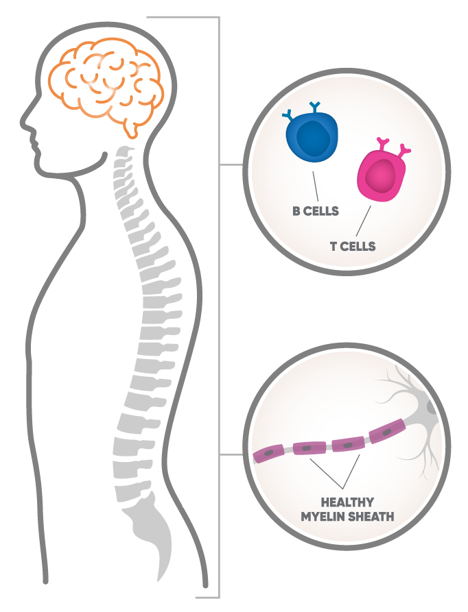 Illustration of human body highlighting brain and spinal cord with a callout to adaptive B and T immune cells and a second callout below of a healthy myelin sheath.